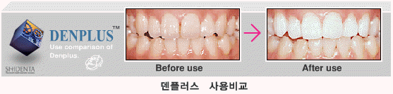 덴플러스 사용비교